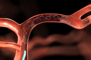 Revolutionary device proves a lifeline for stroke patients