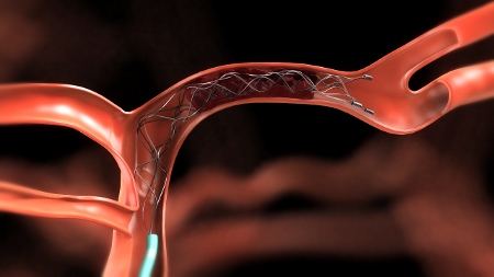 Revolutionary device proves a lifeline for stroke patients