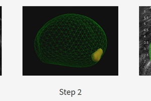 Revolutionary technology pinpoints biopsies to detect prostate cancer