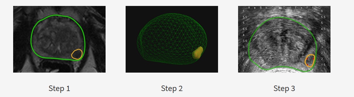 Revolutionary technology pinpoints biopsies to detect prostate cancer