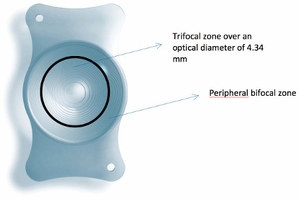 Revolutionary trifocal implant offers new solution for cataract surgery