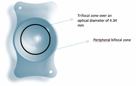 Revolutionary trifocal implant offers new solution for cataract surgery