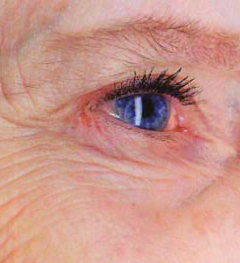 Sheffield hospital first to offer innovative new treatment for wet AMD