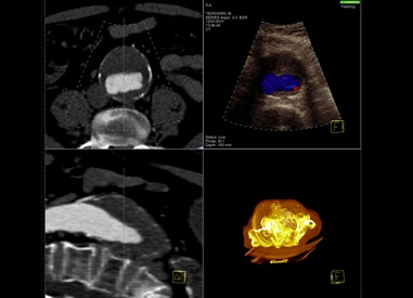 Siemens improves ultrasound diagnostics
