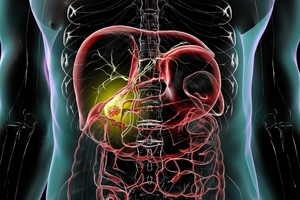 Surgical team removes record number of gall bladders in one day with robotic help