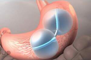 UK patient slims down thanks to revolutionary new weight loss device