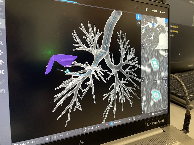 Ion's minimally-invasive approach carries less risk for patients