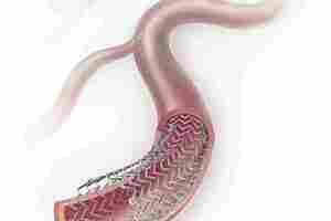 UK surgeons 'slow' to adopt new device that could prevent amputations
