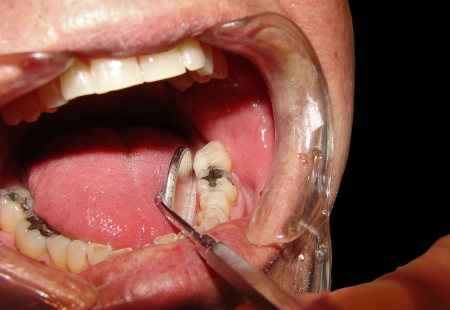 Warning to dentists after counterfeit devices sold on auction websites